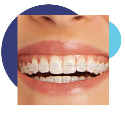 Braces in Myrtle Beach - Orthodontist | Munn and Becker Orthodontics ...