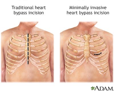 Heart bypass surgery Information | Mount Sinai - New York