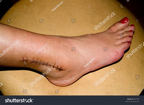 Ankle Surgery: Over 6,870 Royalty-Free Licensable Stock Photos | Shutterstock