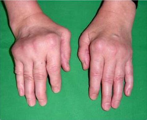 Understanding Rheumatoid Arthritis: Symptoms, Causes, and Treatments - Becker Spine