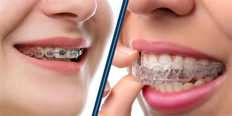 What Is The Difference Between Braces And Retainers?