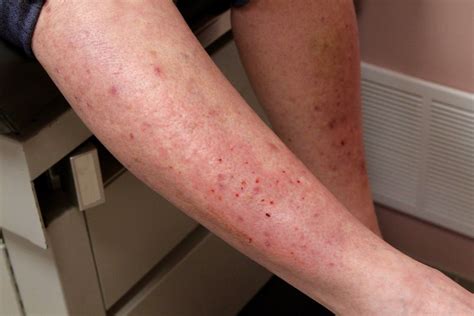 Celiac Disease Rash: Overview, Symptoms and Treatment - HealthPulls