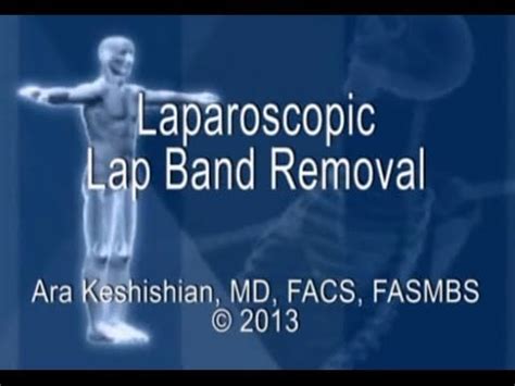 Laparoscopic Lap-Band® Removal - DSSurgery