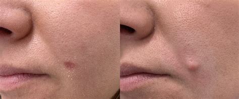 Laser Mole Removal Aftercare: Tips and Advice