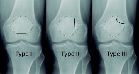 Bipartite patella classification described by Saupe (1921). | Download Scientific Diagram