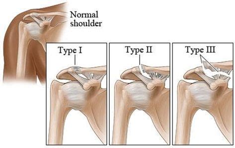 acromioclavicular joint