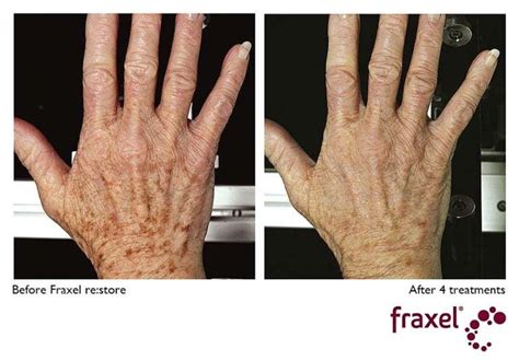 Fraxel laser for scars, spots and stretch marks