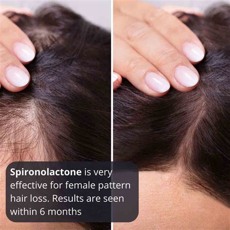 Spironolactone - Dr Davin Lim