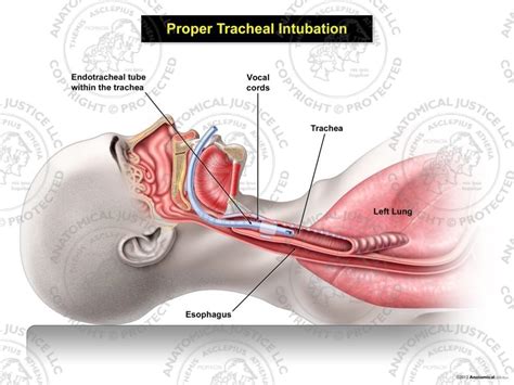 Proper Female Tracheal Intubation