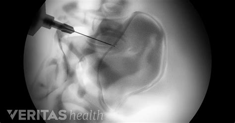 Sacroiliac Joint Injection