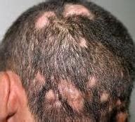 Hair Loss Fungal / Hair Scalp And Nail Conditions Types Causes And Treatments ...