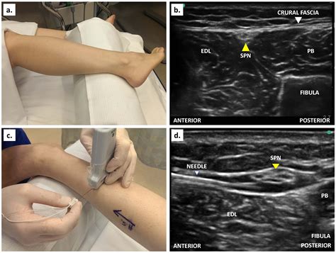 How I Do It: Ultrasound-Guided Ankle Block