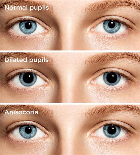 Pupilas dilatadas: Causas, preocupaciones y tratamiento | Todo sobre la ...