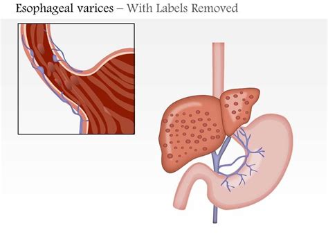 0814 Esophageal Varices Medical Images For Powerpoint | PowerPoint ...