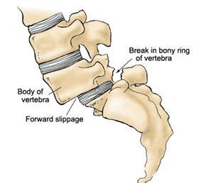 31 best images about Orthopedic Injury of the Spine on Pinterest