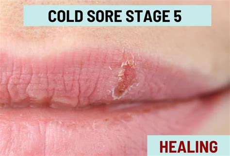 Cold Sore Stages, with Pictures