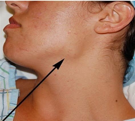 Neck Lymph Nodes Cancer