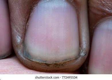 Close Dirty Fingernails Stock Photo 772495534 | Shutterstock