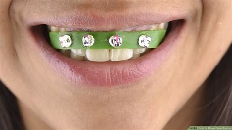 Diy Braces At Home at melissadfpowell blog