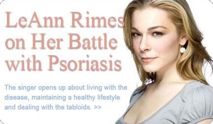 LeAnn Rimes on Her Battle with Psoriasis. MetaDerm Eczema, Baby Eczema, Psoriasis Relief. Free ...