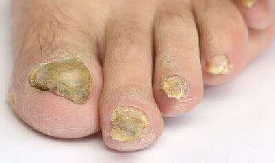 Why Are My Toenails Thick | Renew Physical Therapy