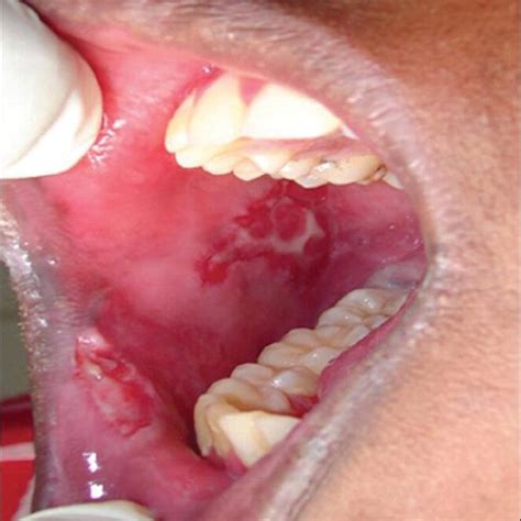 Oral Cancer Buccal Mucosa