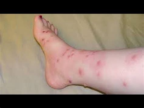 Hiv Rash On Feet