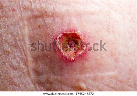 Wound Keratoacanthoma Three Days After Treatment Stock Photo 1745246672 ...