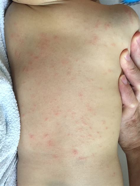 Dust Mite Skin Allergy Symptoms