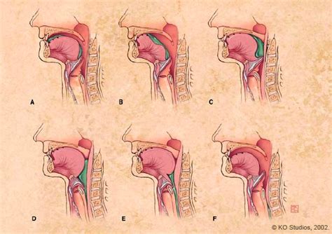 Swallowing | Medical Speech Pathology