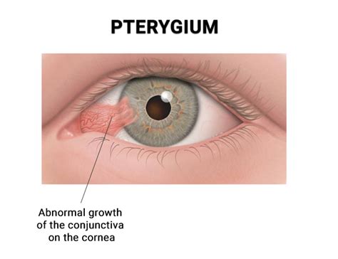 Pterygium Treatment & Removal in NYC - Award Winning Eye Doctors