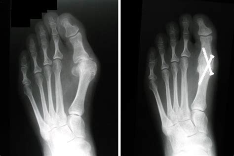 Bunion Surgery - OrthoInfo - AAOS