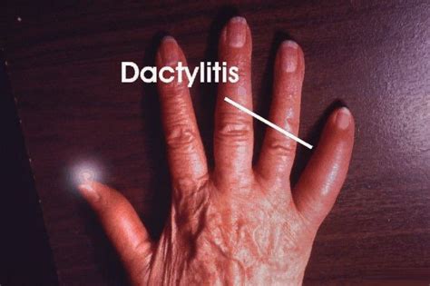 Dactylitis - MEDizzy