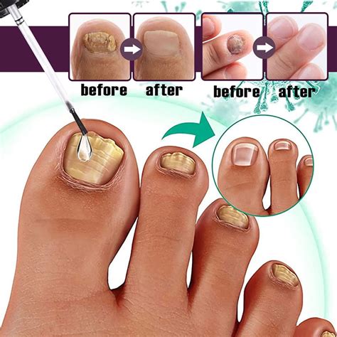 30ml Nail Fungus Treatment Serum Fast-acting Nail Discoloration ...