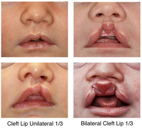 Cleft Lip and Cleft Palate - Dell Children's Craniofacial Team of Texas