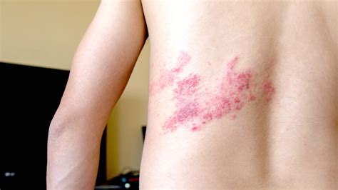 What Is Shingles? Causes, Treatment, and Vaccine Info - GoodRx