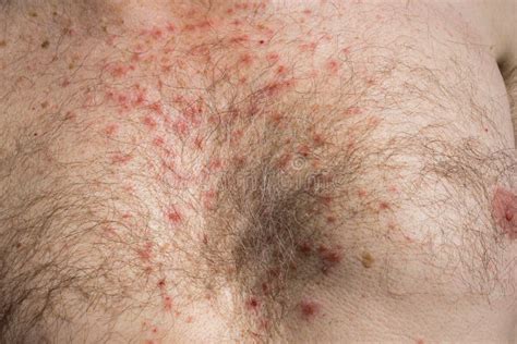 Chest Skin Rash As Drug Side Effect after Surgery Stock Image - Image ...