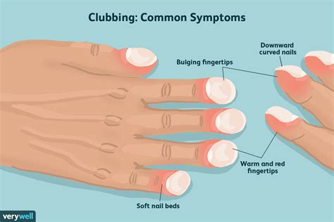 Causes and Phases of Finger Clubbing - MEDizzy