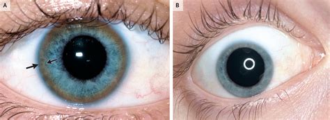 Keyser Fleischer rings (Wilson's Disease) : Pathognomonic