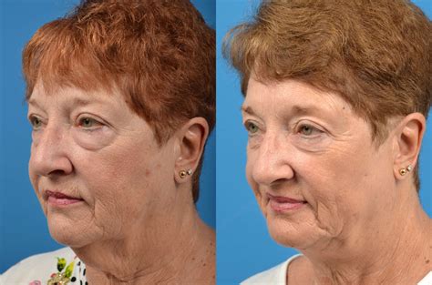 Patient 122406494 | Profile Neck Lift Before & After Photos | Clevens ...