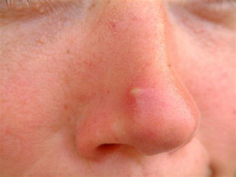 Blind Pimple: Causes, Prevention And Home Remedy