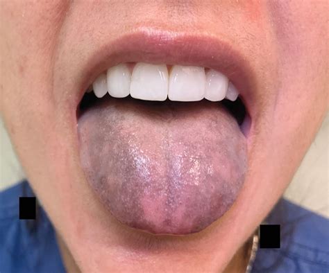 Tongue Discoloration | NEJM | Oral health, Health science, Healthcare ...