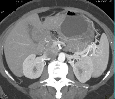 Carcinoma of the Uncinate Process - Pancreas Case Studies - CTisus CT Scanning