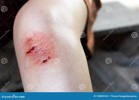 Bruised Wound Injury on Woman Knee Stock Photo - Image of insurance ...