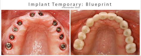 Implant Temporary Crown and Bridge Restorations