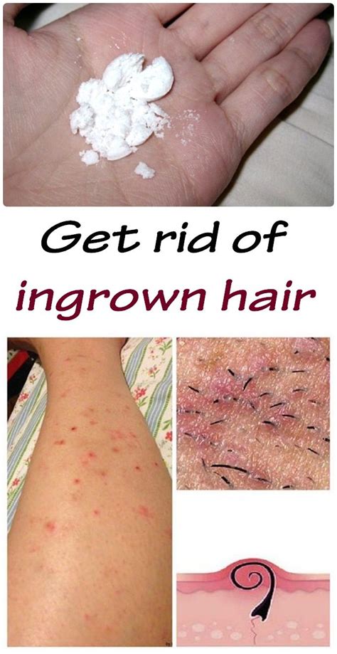 How To Remove Ingrown Hair | Galhairs