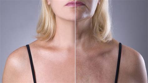 Melasma - Toronto Dermatology Centre