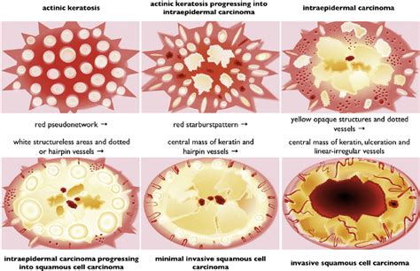 Early Skin Cancer Actinic Keratosis | Hot Sex Picture