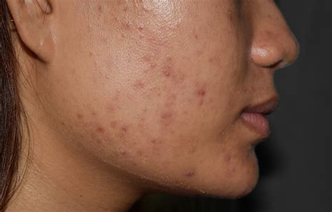 Post-Inflammatory Hyperpigmentation Caused By Acne | Sozo Clinic