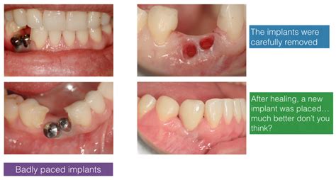 Implant Repair Centre | The Dental Implant Clinic